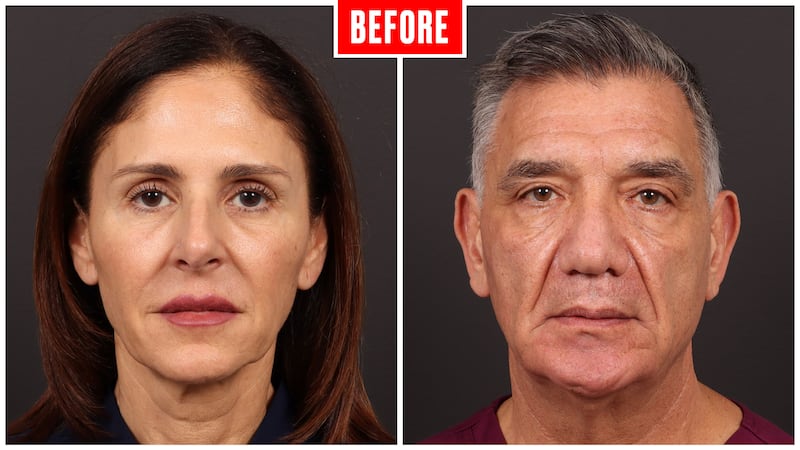 Before and after photos showing a couple who got face lifts