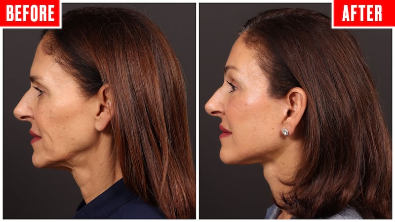Before and after photos showing a couple who got face lifts