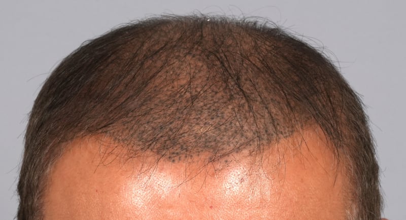 The patient underwent scalp micropigmentation in an effort to conceal his balding, but as his hair kept thinning, the tattoos became more obvious.