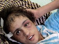articles/2012/01/09/sahar-gul-torture-case-shows-limited-rights-perilous-lives-of-afghan-women/tortured-afghani-girl-lemmon_k2pbwm
