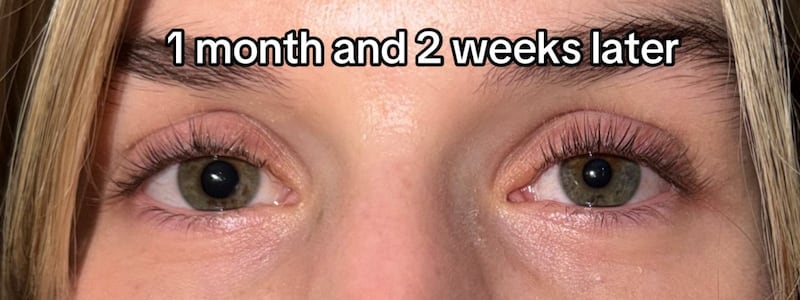 Sarah Bell said her vision began to return after a few weeks, but her pupillary size difference was still present.