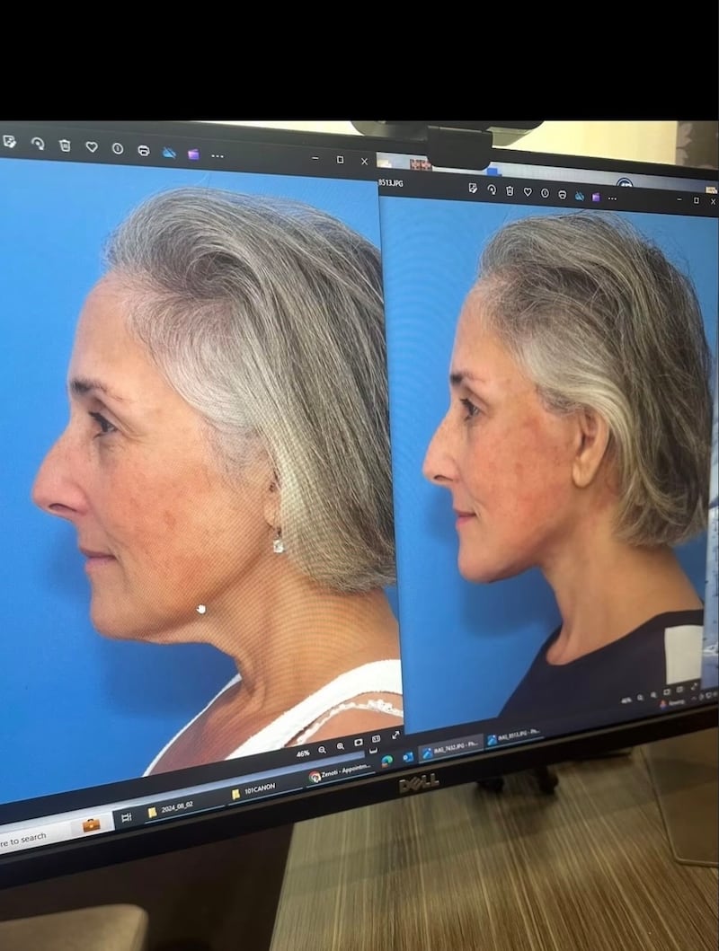 Ricki Lake reveals her before and after facelift photos