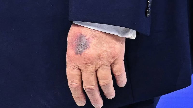 A bruise is visible on the back of US President Donald Trump's left hand as he walks at the "Board of Peace" meeting during the World Economic Forum (WEF) annual meeting in Davos on January 22, 2026.