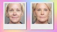 Deep plane face lift before and after. front view.