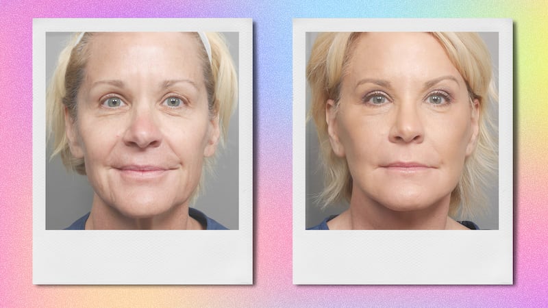 Deep plane face lift before and after. front view.