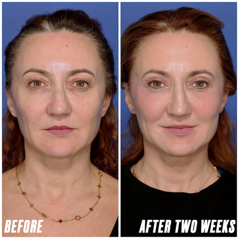 Looker - Her Upper Eyelid Surgery Took Just Two Hours But Took Years Off Her Face