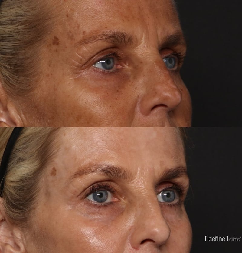 The lasers helped Ulrika Jonsson with sunspots on her forehead.