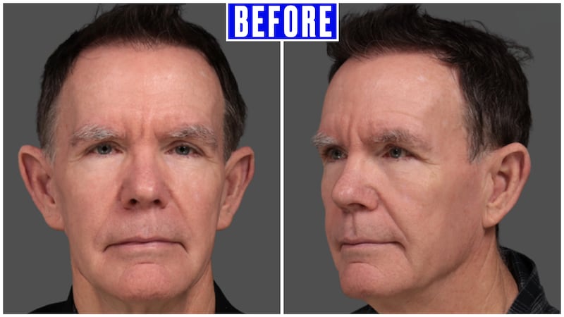 Before and After - The Looker - Man Undergoes Facelift After Noticing His Reflection Looked 'Angry'