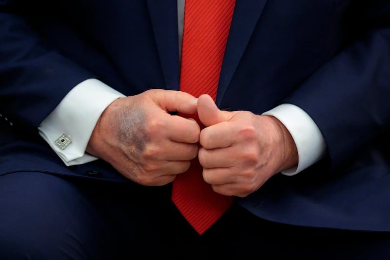 Trump's hands in August of 2025.