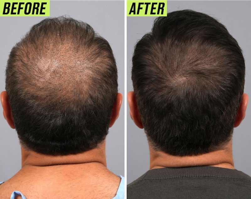 Male hair transformation before and after
