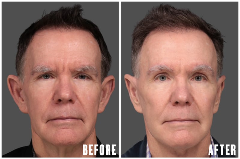 Before and After - The Looker - Man Undergoes Facelift After Noticing His Reflection Looked 'Angry'
