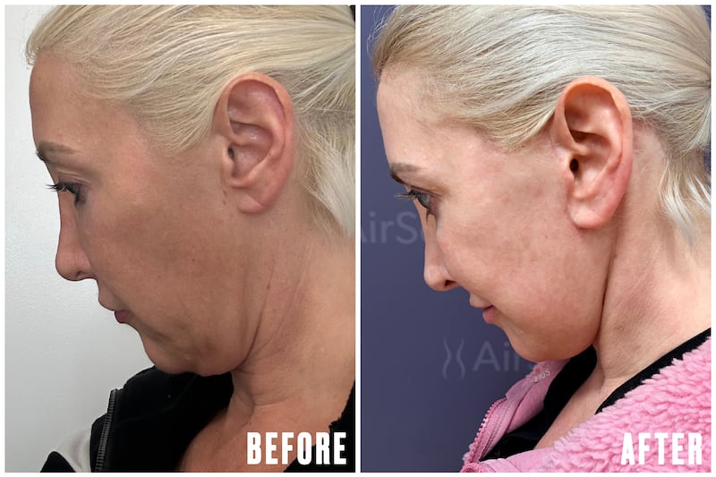 The Looker - Why This Cosmetic Surgeon Got a Facelift at 45