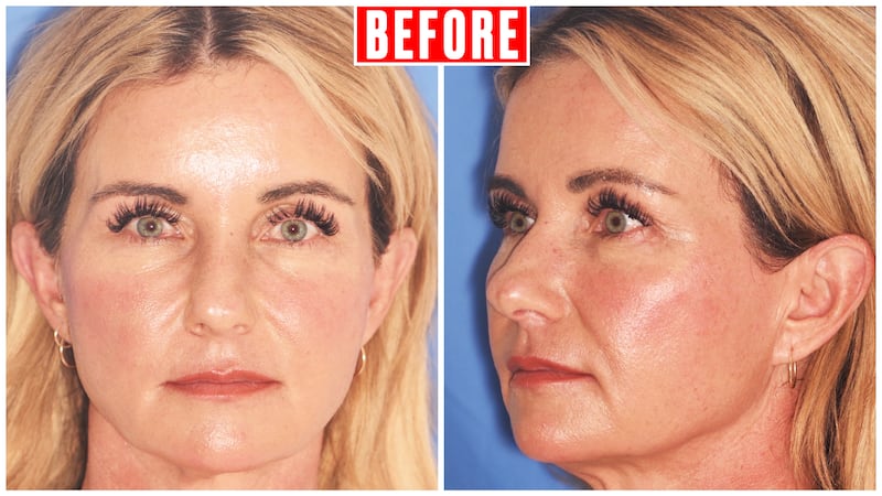 Chari Pack, 51, gets facelift after kids leave home.