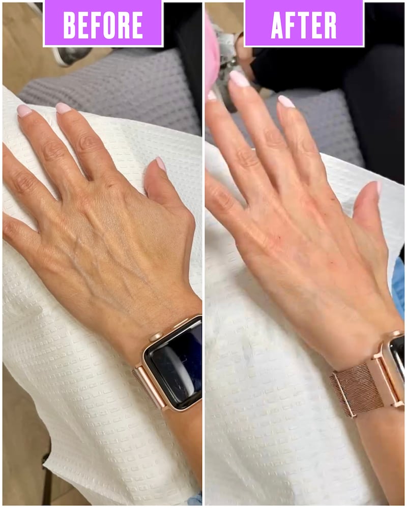 Hand Injection Before and After