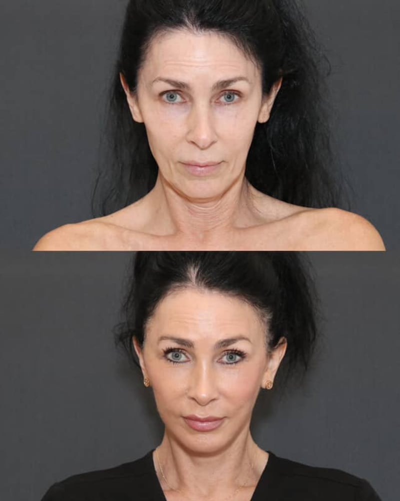 Before and after photos of Dr. L. Mike Nayak's Patient, Kelly Morgan.