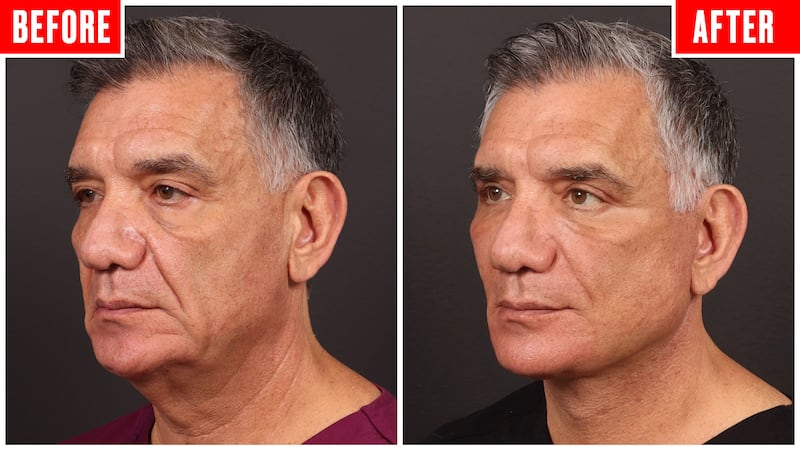 Before and after photos showing a couple who got face lifts