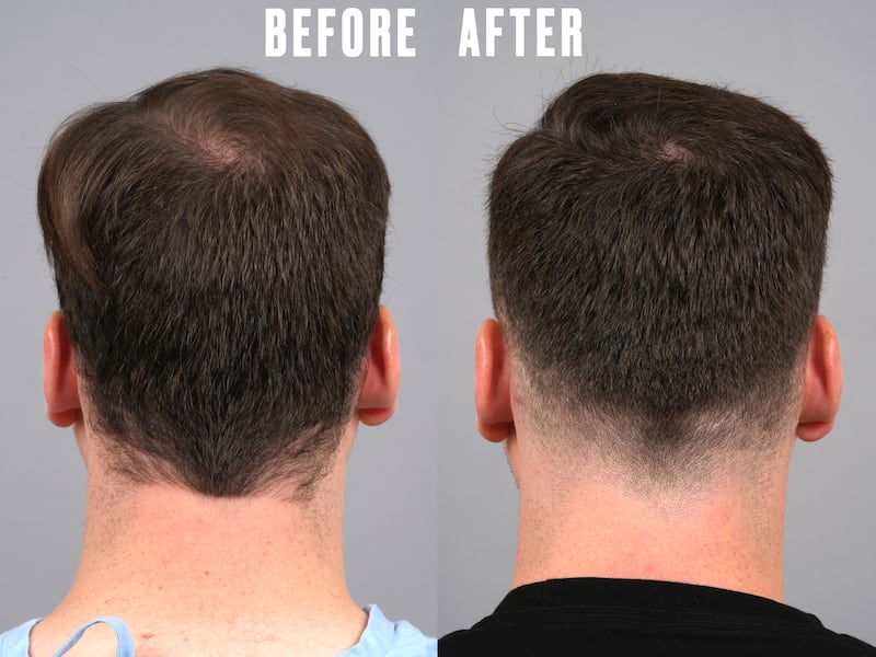 Jordan went through hair transplant surgery with Dr. Gary Linkov at Linkov Hair Surgery in New York City.