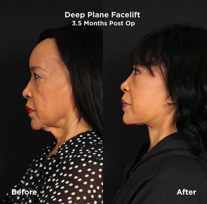 Jackée Harry's deep-plane facelift.
