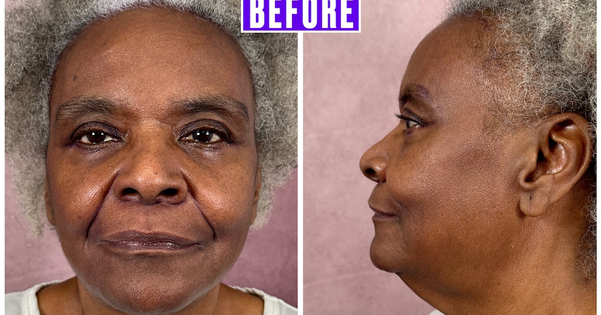Plastic Surgeon Gives His Mother a Facelift and the Results Go Viral