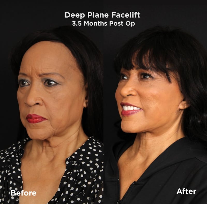 Jackée Harry's deep-plane facelift.