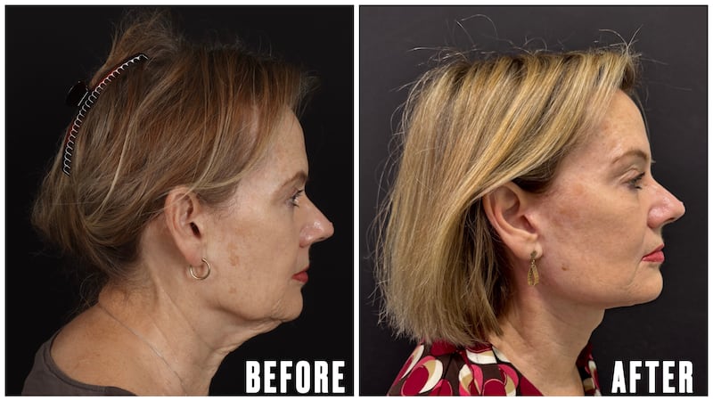 Beverly facelift results for The Looker.