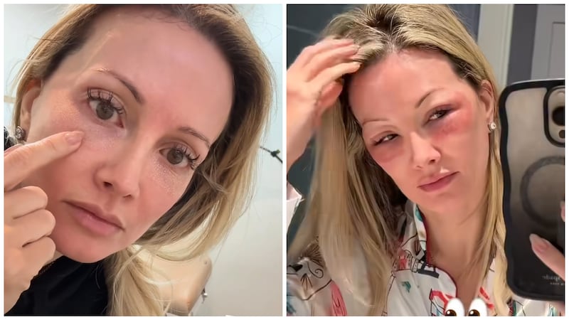 Holly Madison right after her treatment and the next day.