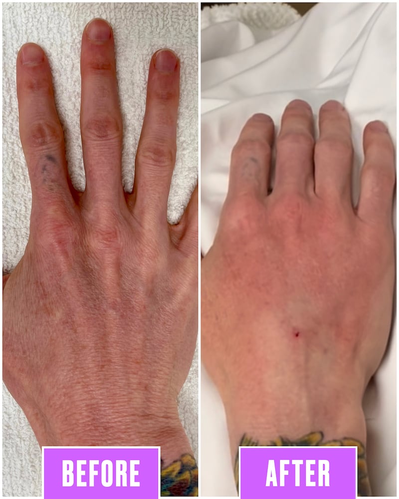 Hand Injection Before and After
