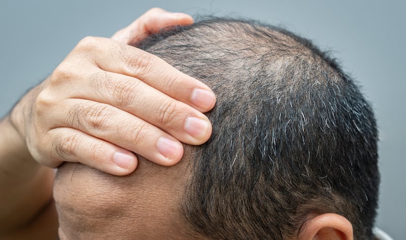 Baldness is usually most noticeable on the scalp, but it can happen anywhere on the body where hair grows.