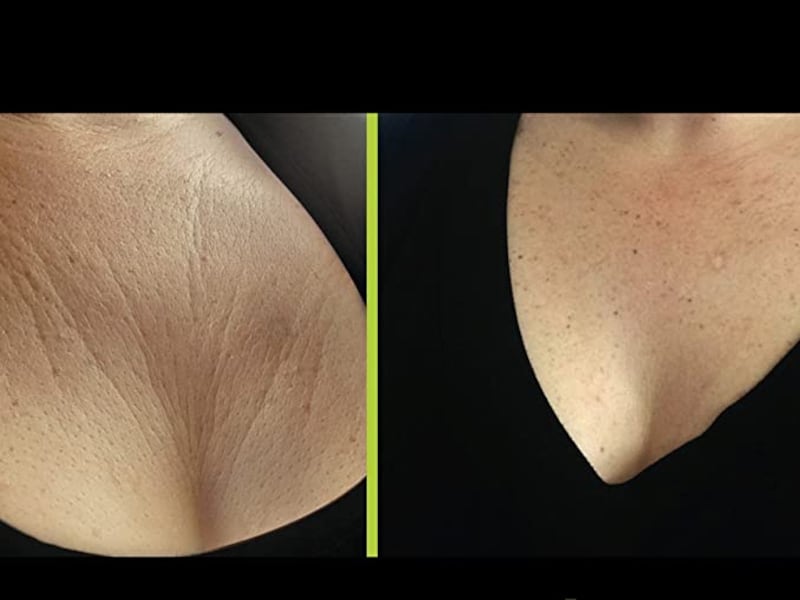 Bravity anti-wrinkle bra before and after