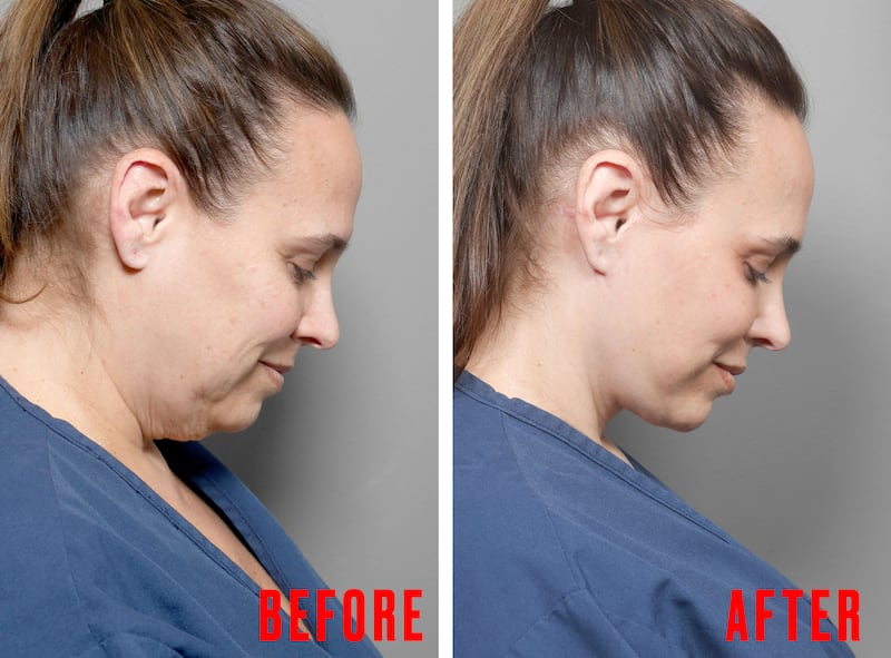Woman Gets a Facelift After Losing 80 Pounds on GLP-1s for the Looker.