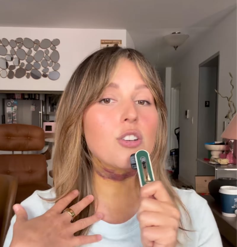Katie Thurston was open about her procedure on social media, even showing the bruising after her surgery.