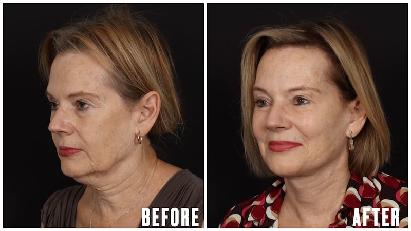 Beverly facelift results for The Looker.