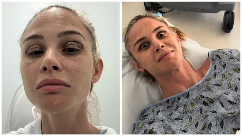 Meghan King showed her social media followers her entire journey with an upper blepharoplasty, under-eye fat grafting, and UltraClear laser.