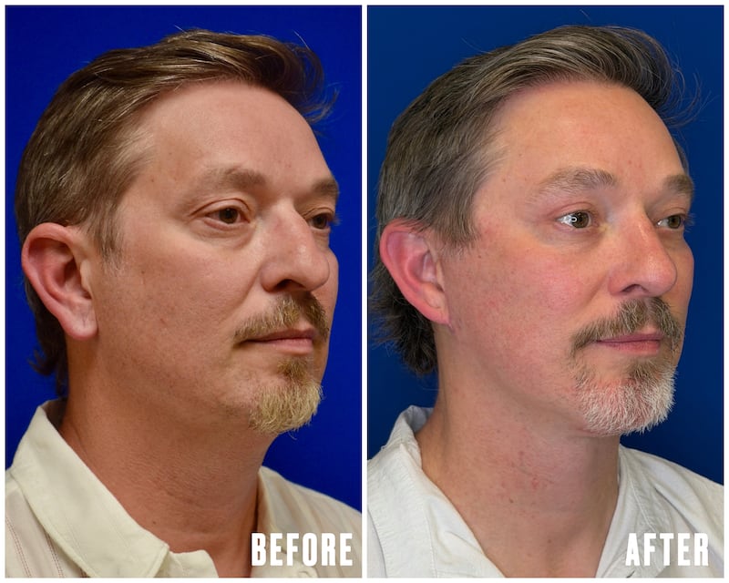 For His 50th Birthday, He Got Six Plastic Surgery Procedures for The Looker